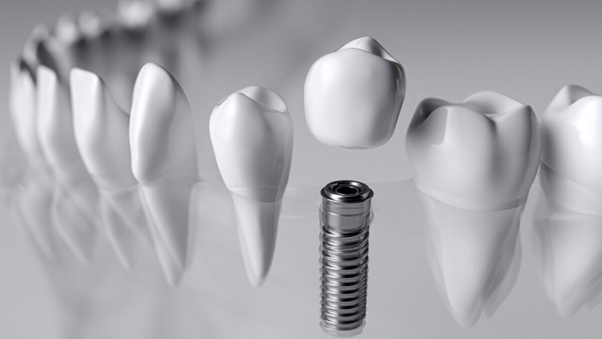 Denti mancanti? In Humanitas Arese visite dedicate all’implantologia dentale